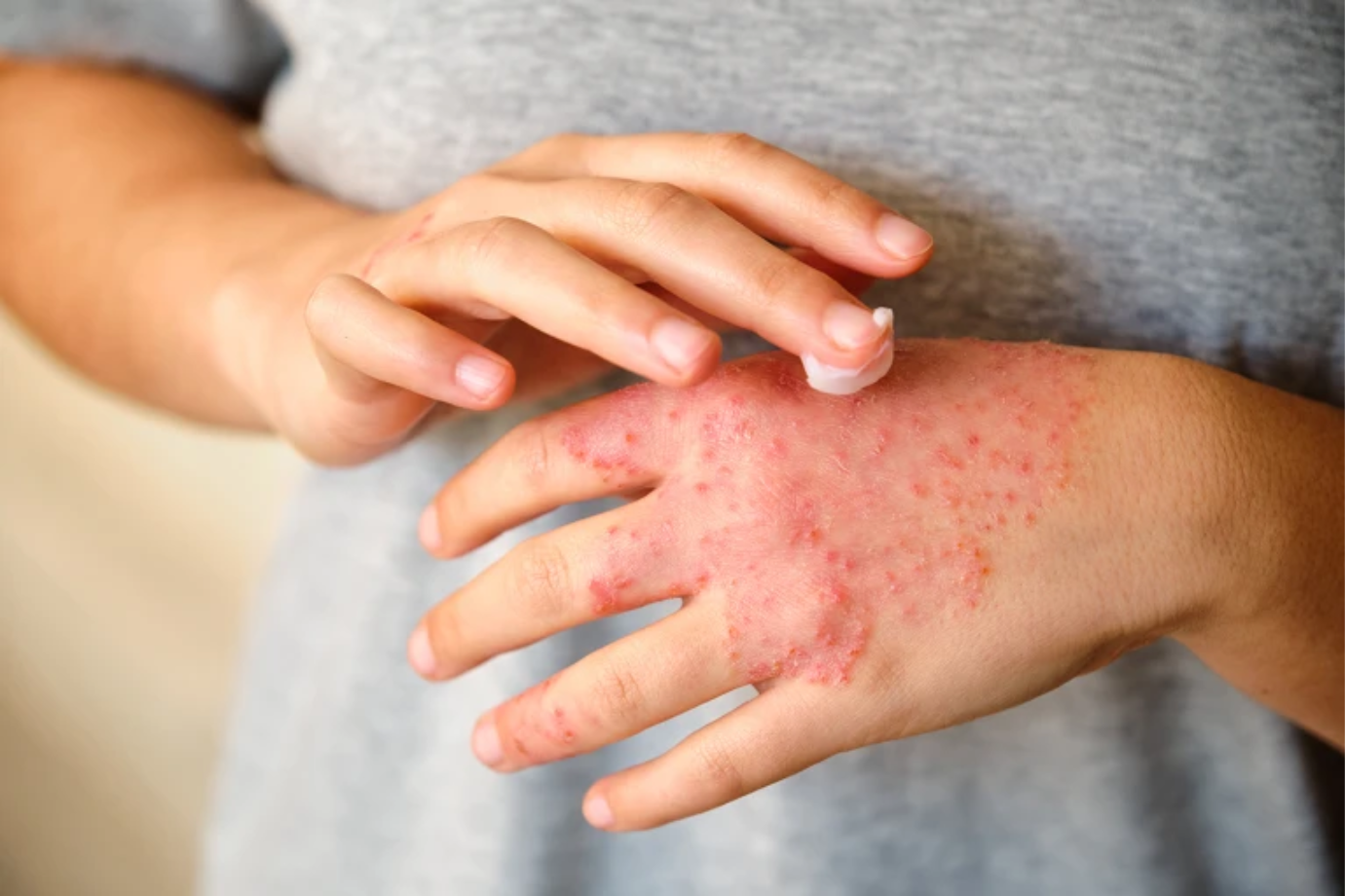 eczema-1